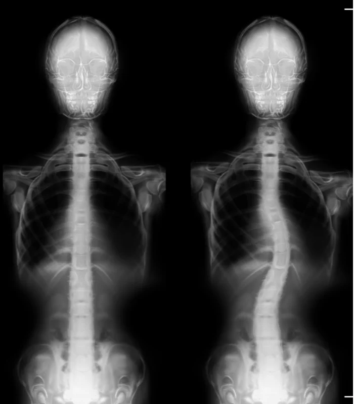 Scoliosis Treatment In Shawnee